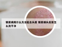 银屑病用什么方法能去头屑 银屑病头皮屑怎么洗干净