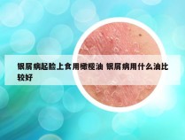 银屑病起脸上食用橄榄油 银屑病用什么油比较好