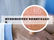 国外银屑病的研究现状 银屑病国外有治愈的吗