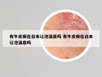 有牛皮癣在日本让泡温泉吗 有牛皮癣在日本让泡温泉吗
