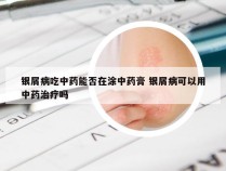 银屑病吃中药能否在涂中药膏 银屑病可以用中药治疗吗
