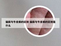 猫藓与牛皮癣的区别 猫藓与牛皮癣的区别是什么