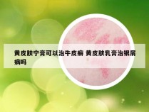 黄皮肤宁膏可以治牛皮癣 黄皮肤乳膏治银屑病吗