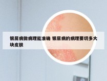 银屑病做病理能准确 银屑病的病理要切多大块皮肤