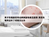 男子生殖器官旁边两侧部有癣怎回事 男性生殖旁边长了疙瘩怎么办