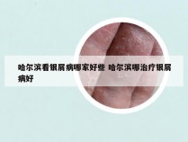 哈尔滨看银屑病哪家好些 哈尔滨哪治疗银屑病好