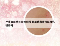 严重银屑病可以母乳吗 银屑病患者可以母乳喂养吗
