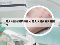 男人大腿内侧长藓图片 男人大腿内侧长藓图片