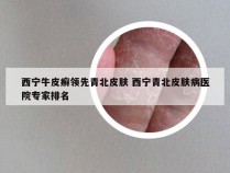 西宁牛皮癣领先青北皮肤 西宁青北皮肤病医院专家排名