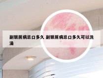 副银屑病忌口多久 副银屑病忌口多久可以洗澡
