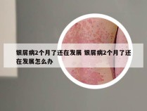 银屑病2个月了还在发展 银屑病2个月了还在发展怎么办