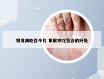 银屑病吃百令片 银屑病吃百合的好处