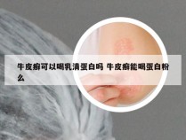 牛皮癣可以喝乳清蛋白吗 牛皮癣能喝蛋白粉么