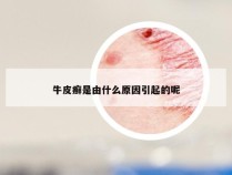 牛皮癣是由什么原因引起的呢