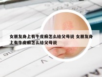 女朋友身上有牛皮癣怎么给父母说 女朋友身上有牛皮癣怎么给父母说