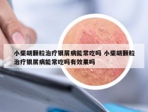 小柴胡颗粒治疗银屑病能常吃吗 小柴胡颗粒治疗银屑病能常吃吗有效果吗