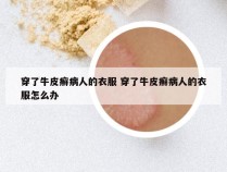 穿了牛皮癣病人的衣服 穿了牛皮癣病人的衣服怎么办