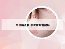 牛皮癣点刺 牛皮肤癣刺挠吗