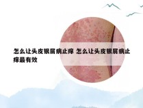 怎么让头皮银屑病止痒 怎么让头皮银屑病止痒最有效