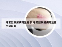 寻常型银屑病用达克宁 寻常型银屑病用达克宁可以吗