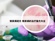 银屑病绝方 银屑病的治疗偏方大全