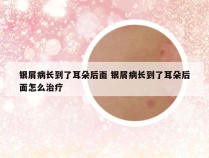 银屑病长到了耳朵后面 银屑病长到了耳朵后面怎么治疗