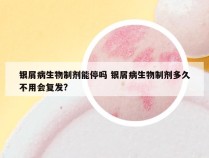银屑病生物制剂能停吗 银屑病生物制剂多久不用会复发?