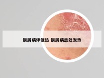 银屑病伴低热 银屑病患处发热
