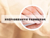 淤热型牛皮癣游泳好不好 牛皮肤癣能游泳吗