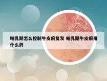 哺乳期怎么控制牛皮癣复发 哺乳期牛皮癣用什么药