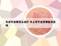 头皮牛皮癣怎么治疗 头上生牛皮皮癣能自愈吗