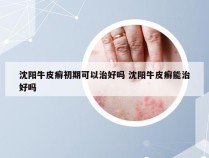 沈阳牛皮癣初期可以治好吗 沈阳牛皮癣能治好吗