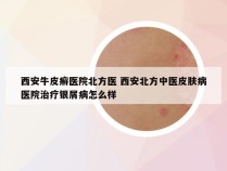 西安牛皮癣医院北方医 西安北方中医皮肤病医院治疗银屑病怎么样