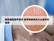 银屑病是指甲变空 指甲银屑病为什么指甲会变厚