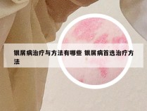 银屑病治疗与方法有哪些 银屑病首选治疗方法