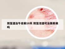 斑蝥酒治牛皮癣10天 斑蝥泡酒可治银屑病吗