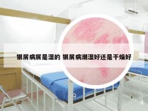银屑病屑是湿的 银屑病潮湿好还是干燥好
