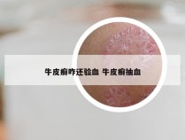 牛皮癣咋还验血 牛皮癣抽血