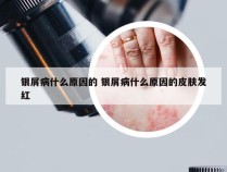 银屑病什么原因的 银屑病什么原因的皮肤发红