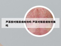 芦荟胶对银屑病有效吗 芦荟对银屑病有效果吗