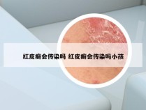 红皮癣会传染吗 红皮癣会传染吗小孩