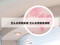 怎么会得银屑病 怎么会得银屑病呢