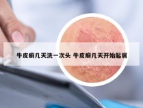 牛皮癣几天洗一次头 牛皮癣几天开始起屑