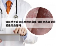 银屑病导致肾炎导致高血压 银屑病患者更容易患高血压吗