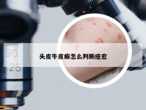 头皮牛皮癣怎么判断痊愈