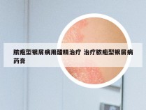 脓疱型银屑病用醋精治疗 治疗脓疱型银屑病药膏