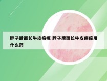 脖子后面长牛皮癣痒 脖子后面长牛皮癣痒用什么药