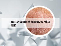 miR146a银屑病 银屑病2017成功新药