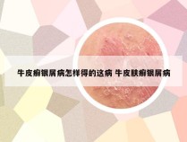牛皮癣银屑病怎样得的这病 牛皮肤癣银屑病