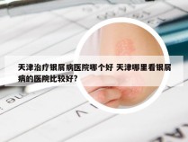 天津治疗银屑病医院哪个好 天津哪里看银屑病的医院比较好?